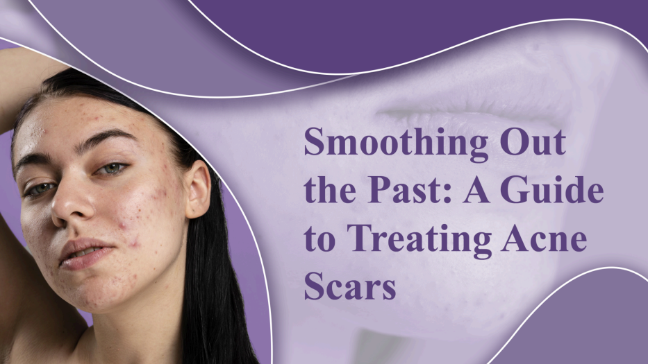 Smoothing Out the Past: A Guide to Treating Acne Scars