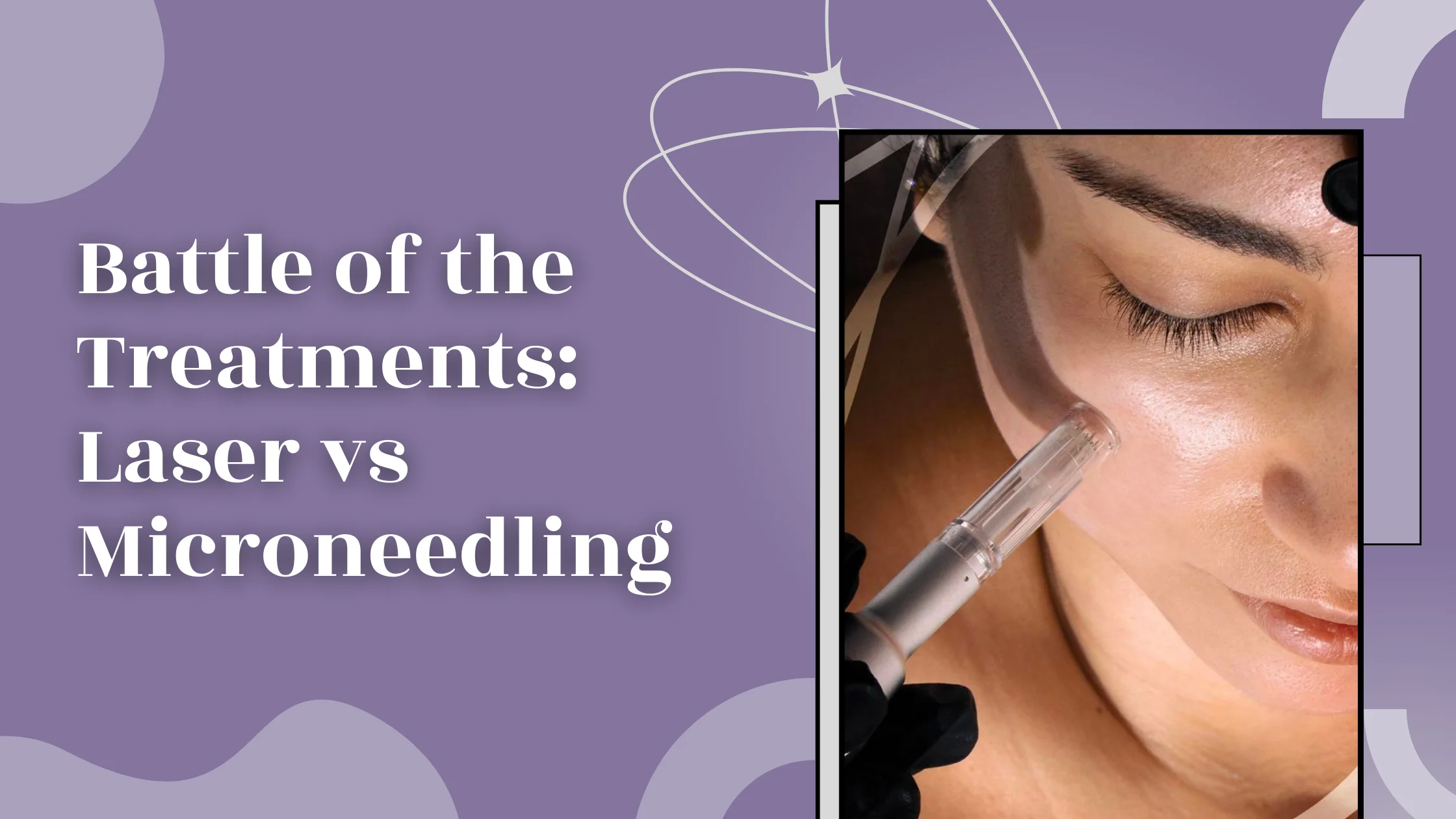 Battle of the Treatments Laser vs. Microneedling