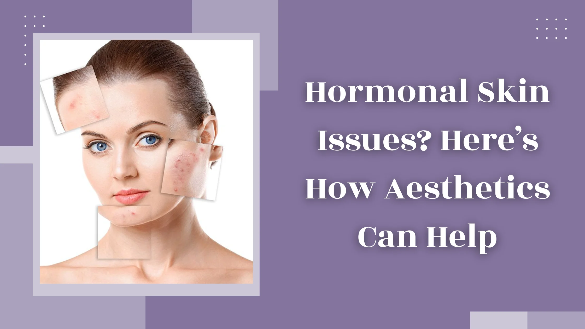 Hormonal Skin Issues ? Here’s How Aesthetics Can Help