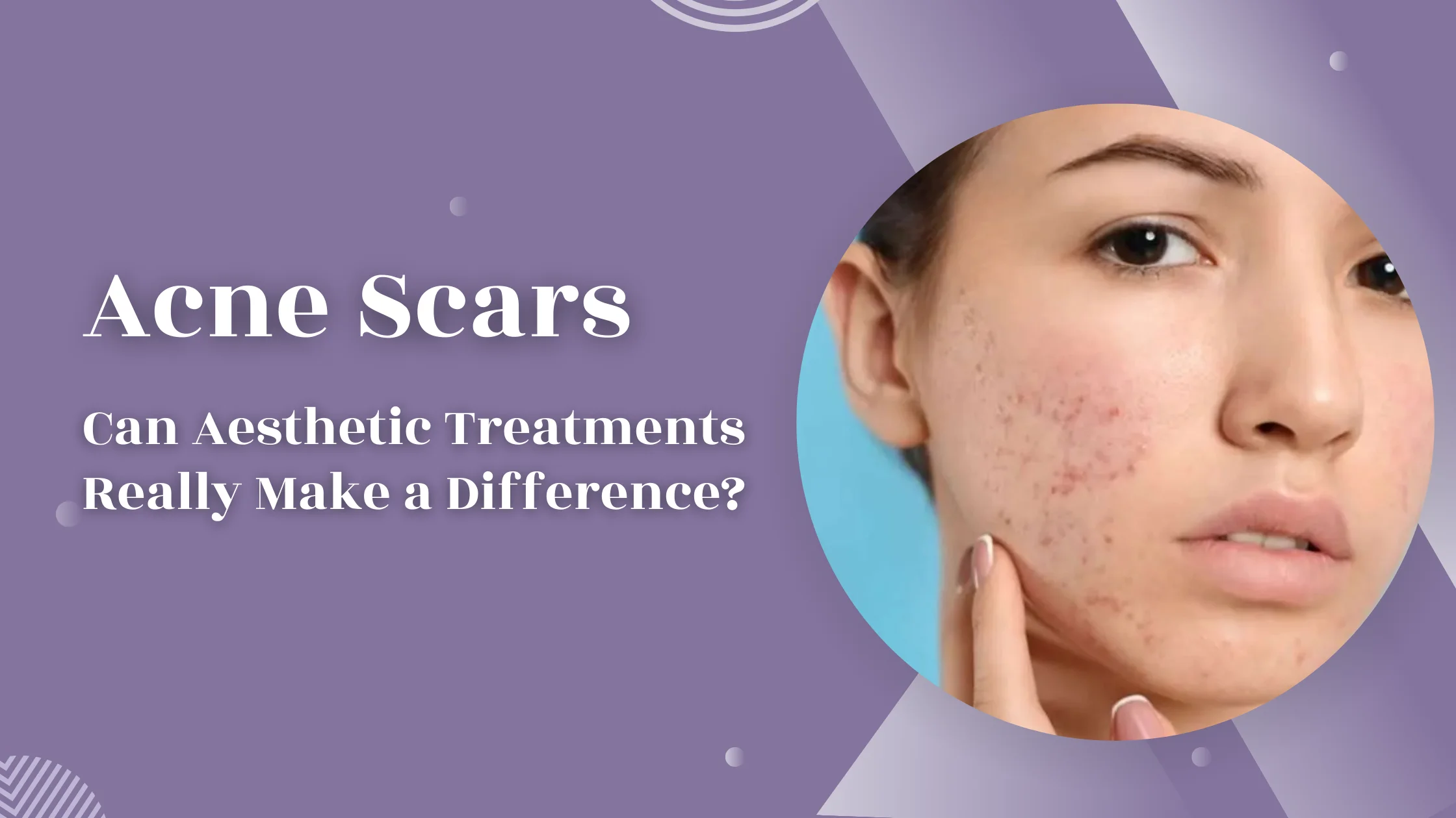 Acne Scars: Can Aesthetic Treatments Really Make a Difference?