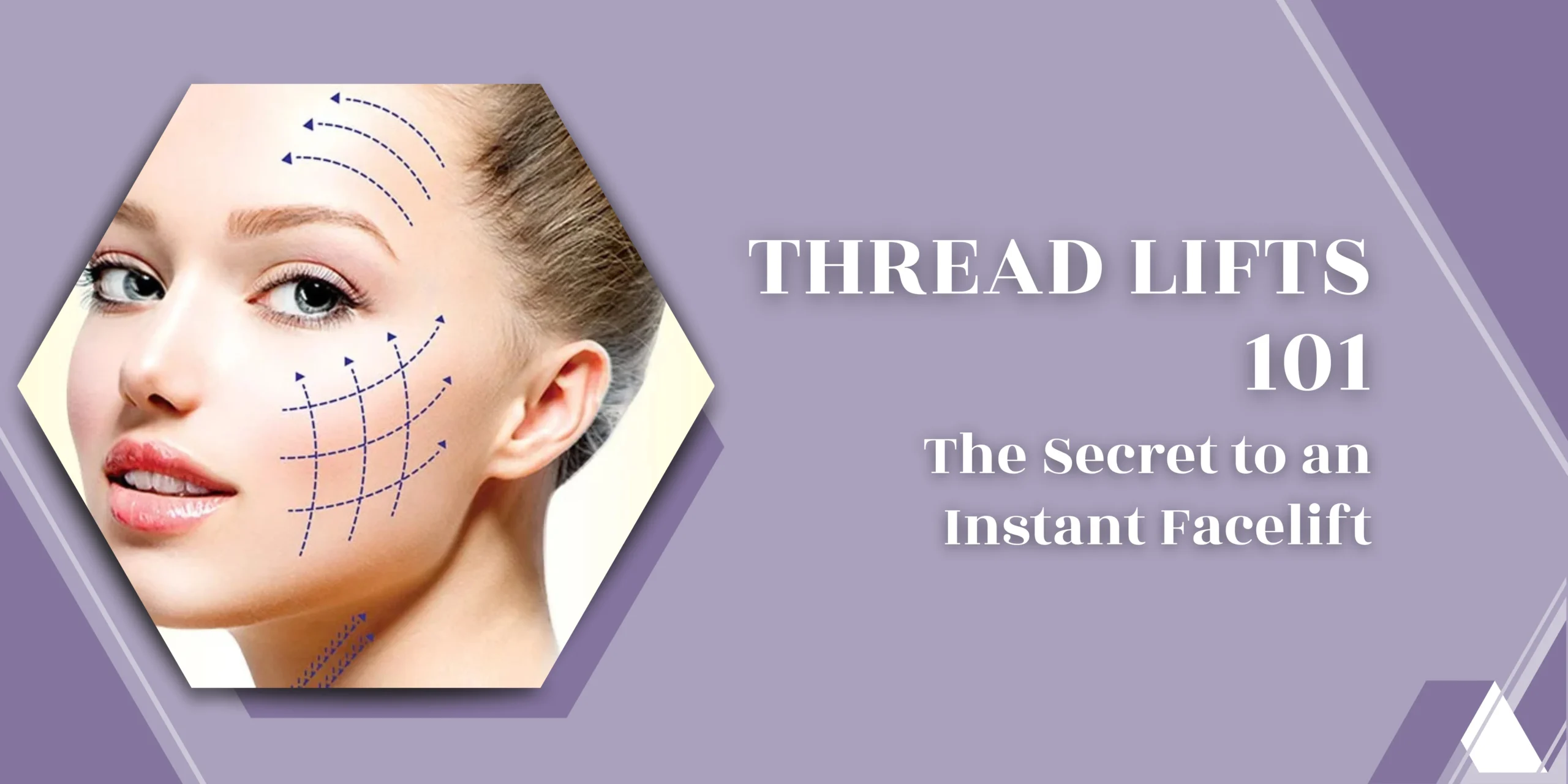 Thread Lifts 101: The Secret to an Instant Facelift