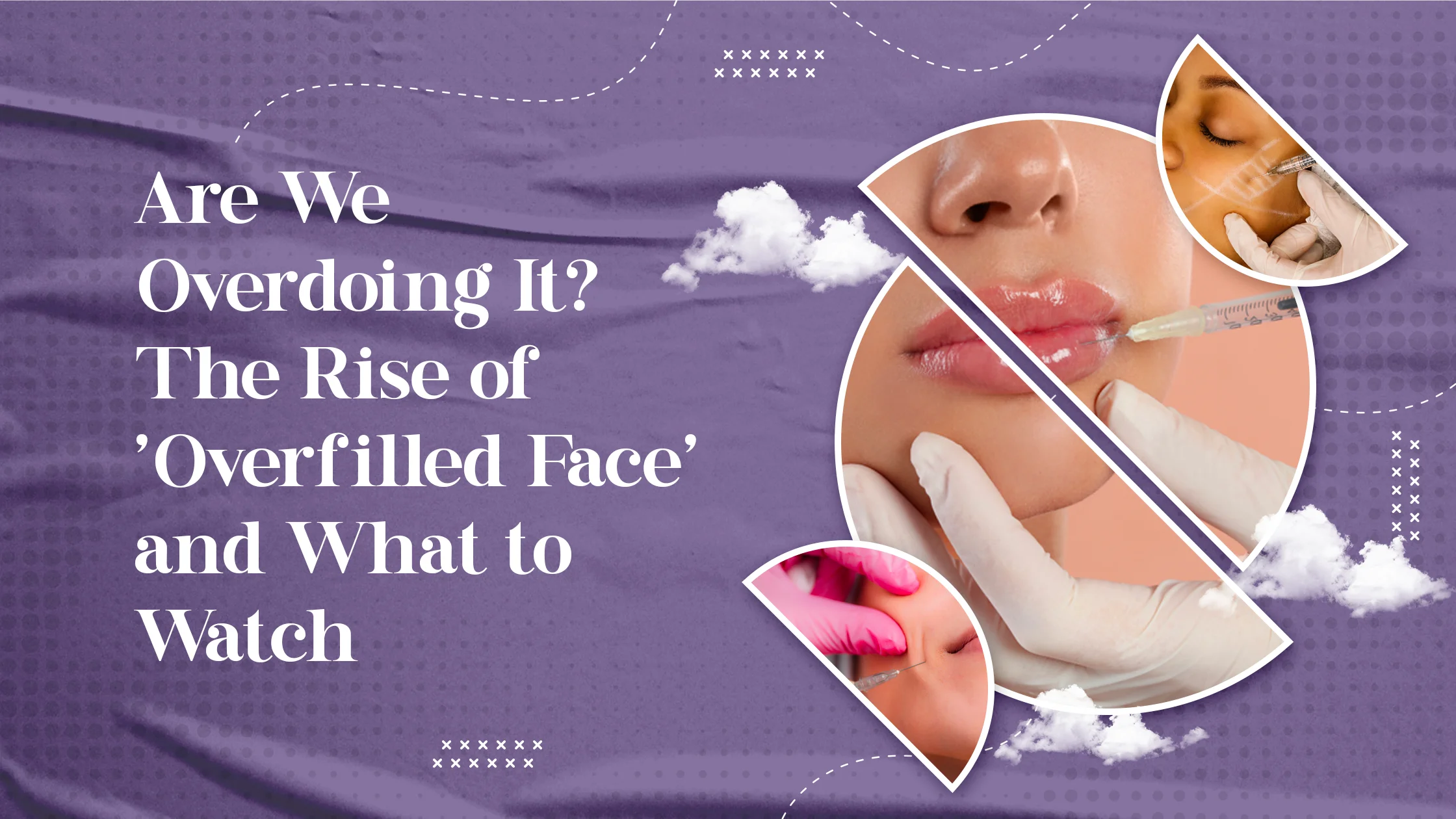 Are We Overdoing It? The Rise of ‘Overfilled Face’ and What to Watch